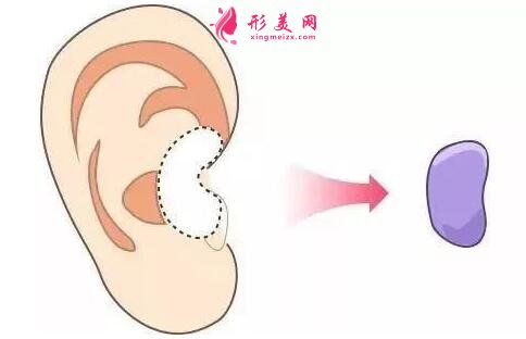 耳軟骨.jpg
