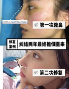 重慶軍美做的肋軟骨隆鼻修復(fù)，術(shù)后鼻子超好看
