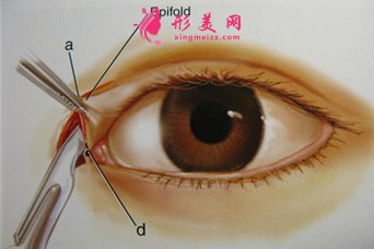 開內眼角常見的風險