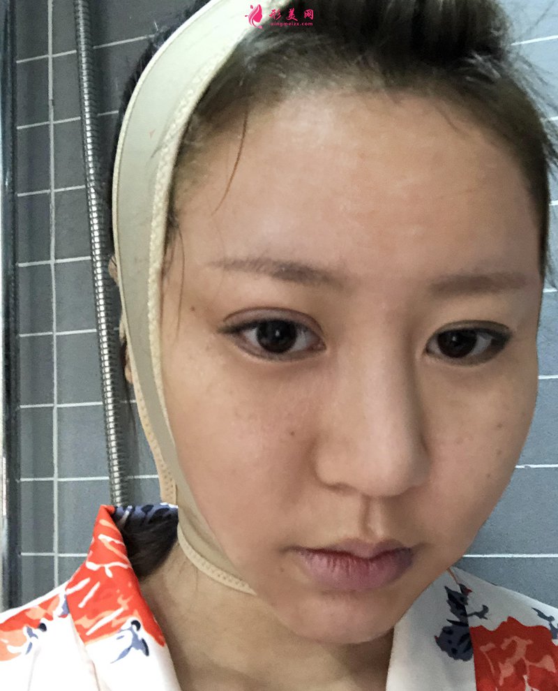 上海自體脂肪面部填充前后對比圖