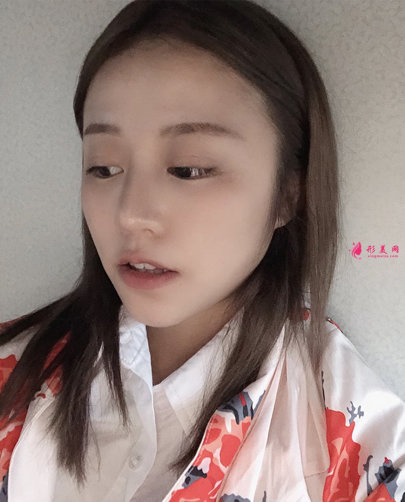 上海自體脂肪面部填充前后對比圖