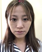 上海華美自體脂肪面部填充前后對(duì)比圖