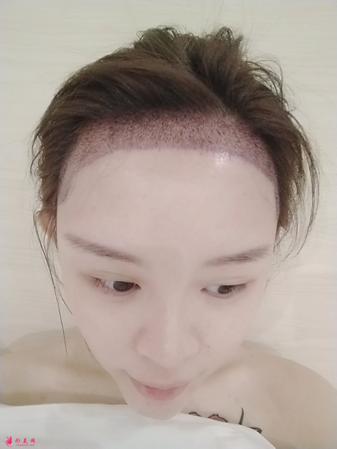 植發(fā)的效果能保持多久？