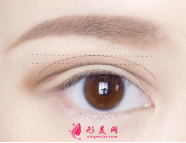 雙眼皮手術(shù)什么時候恢復(fù)自然