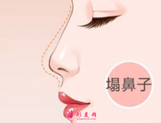 達拉斯隆鼻大概需要多少錢？