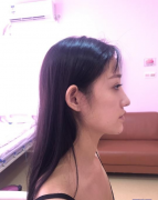 廣州廣大整形醫(yī)院做隆鼻效果怎么樣呢？術后3個月分享