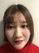 南京華美美容醫(yī)院隆鼻怎么樣？，200天效果分享