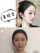 重慶聯(lián)合麗格美容醫(yī)院做的鼻綜合，超級自然的媽生款！