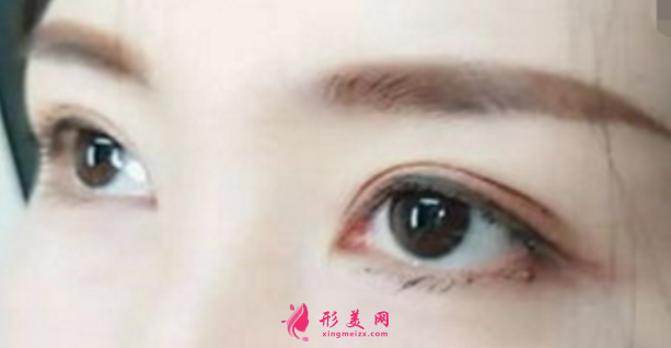 雙眼皮手術(shù)方法有哪幾種呢