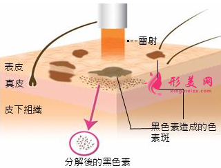 激光祛斑大概需要做幾次