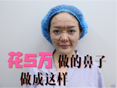 在上海九院王濤花5萬做的鼻綜合，總算沒有白費錢!