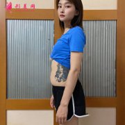 北京潤美玉之光王明利醫(yī)生腰腹吸脂術后恢復效果展示