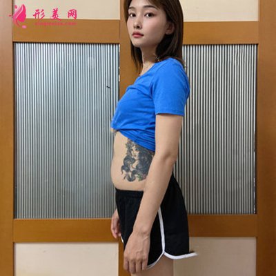 合肥小姐姐腰腹吸脂術(shù)后恢復(fù)效果展示