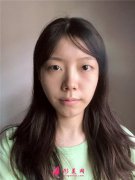 杭州同榮麗格切開雙眼皮術后恢復效果反饋