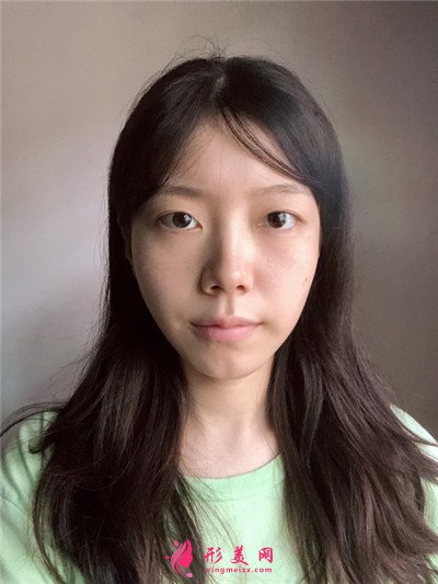杭州切開(kāi)雙眼皮術(shù)后恢復(fù)效果反饋