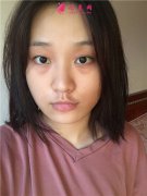 杭州同榮麗格醫(yī)療美容面部埋線提升術后恢復情況對比