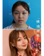 四川華人醫(yī)聯(lián)做的面部吸脂案例！超快的瘦臉方法，大贊