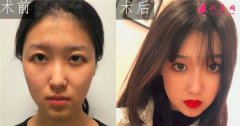 北京潤美玉之光自體脂肪面部填充案例分享！術(shù)后兩個月效果很好