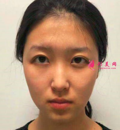 寧波靜港整形自體脂肪面部填充案例