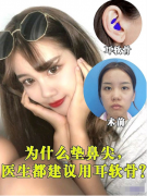 南京美貝爾整形醫(yī)院的黃名斗醫(yī)生隆鼻案例，做出的鼻尖真的太美了