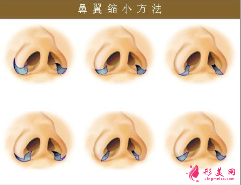 縮鼻手術(shù)后遺癥是什么