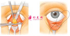祛眼袋術(shù)后幾天恢復(fù)？