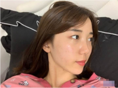 武漢藝星醫(yī)療美容醫(yī)院自體脂肪面部填充怎么樣？填充案例分享