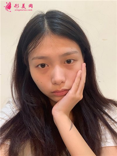 成都切開雙眼皮術(shù)后恢復(fù)效果分享圖