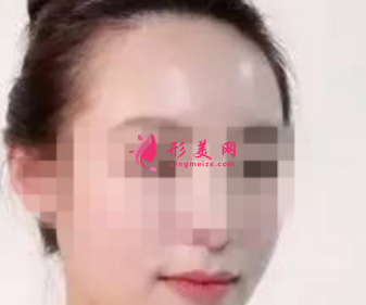 自體脂肪填充臉部恢復時間要多久