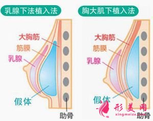 假體隆胸可以哺乳么
