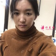 杭州華山連天美熱瑪吉術(shù)后恢復(fù)情況對(duì)比