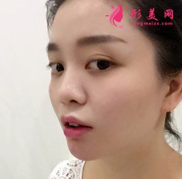 上海注射玻尿酸效果驚艷 術(shù)后 上海注射玻尿酸效果驚艷