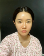 上海九院周雙白醫(yī)生做的全切雙眼皮，術(shù)后案例分享