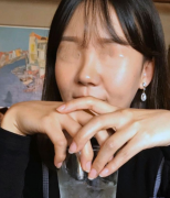 上海九院張路做的肋軟骨鼻綜合案例分享，這鼻子你喜歡嗎