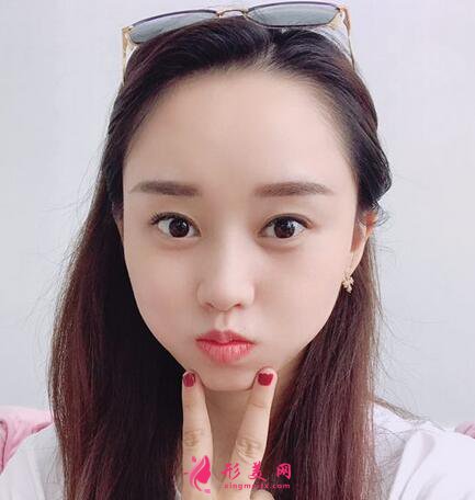 #術前了解#熱瑪吉除皺能維持多久？效果好不好呢？