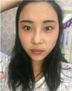 上海九院硅膠隆鼻需要多少錢？隆鼻術(shù)后案例分享