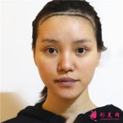 南京碧蓮盛小姐姐種植發(fā)際線術(shù)后效果分享