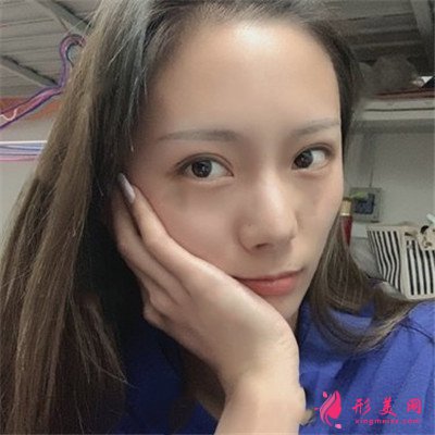 長沙小仙女肋軟骨隆鼻術后效果分享