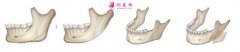 磨骨手術(shù)哪家好？內(nèi)附國內(nèi)醫(yī)院名單分享及簡介