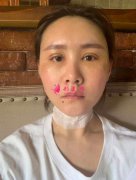 上海九院蘇薇潔雙眼皮案例！整形項(xiàng)目價(jià)格表和恢復(fù)照片公開一覽