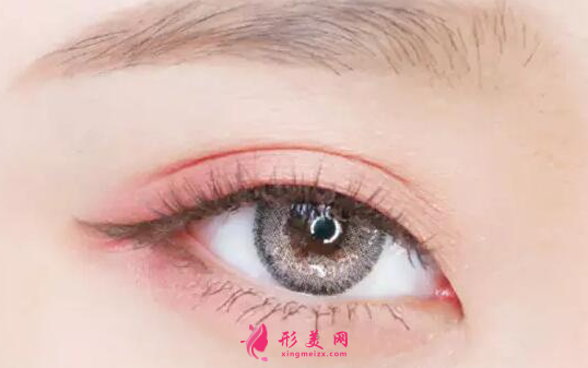 開眼角的術(shù)后效果自然嗎