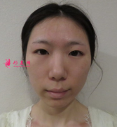 寧波韓美美容醫(yī)院割雙眼皮，眼睛基礎(chǔ)不好只能做全切