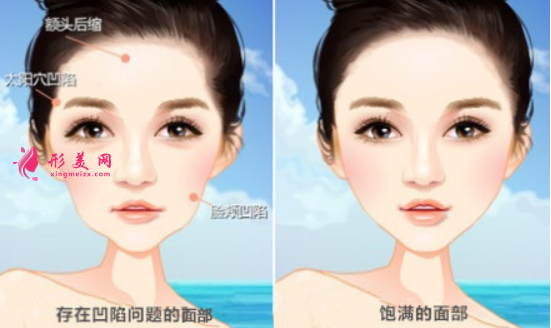 自體脂肪填充面部要忌口多久