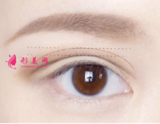 雙眼皮術(shù)后怎么恢復(fù)得快？
