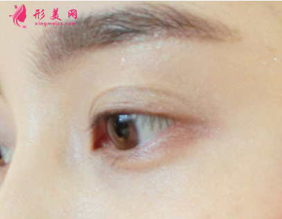 雙眼皮術(shù)對(duì)增大眼睛有效果嗎