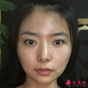 上海華美面部自體脂肪填充效果分享，女神進化史