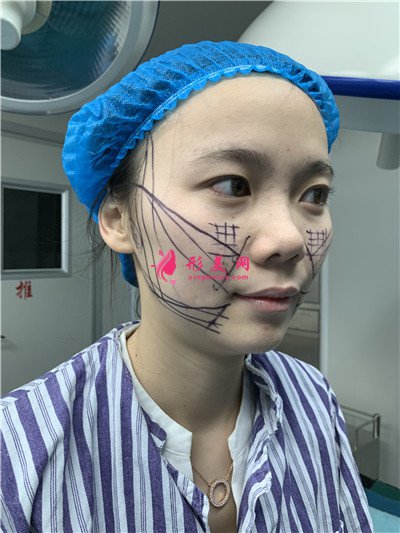 廣州小姐姐面部線雕提升術(shù)后效果對(duì)比