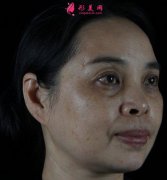 上海九院超皮秒全臉祛斑案例分享，真的很神奇！