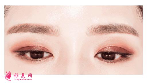 雙眼皮術后腫脹期是怎么樣的