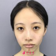 北京聯(lián)合麗格雙眼皮怎么樣？案例圖術(shù)后恢復(fù)記錄新公開~